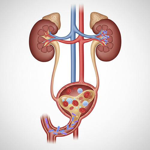 Urinary Tract Infection (UTI)